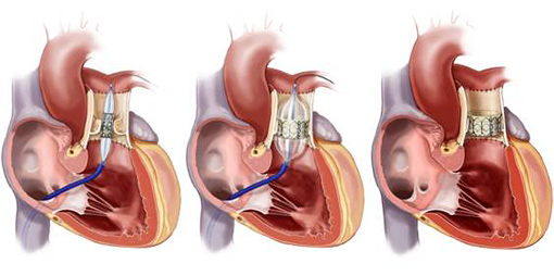 Schema der Pulmonalklappen-OP